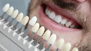 E-Max Veneers