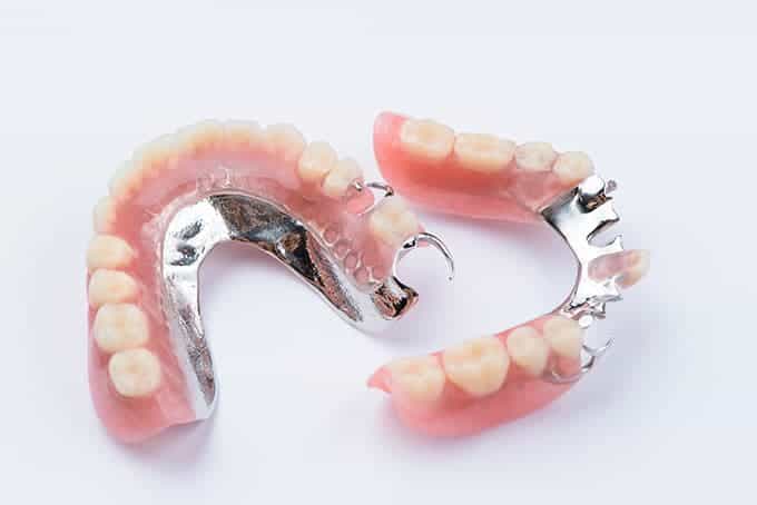 Cast Partial Denture UAE Dental Lab
